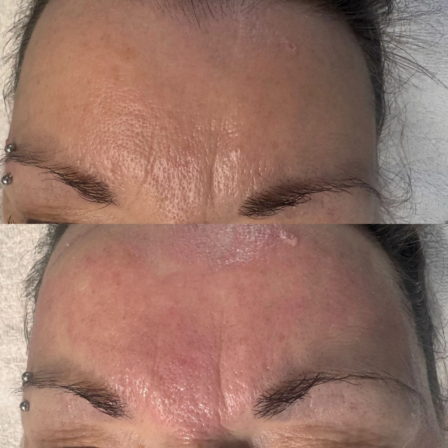El barbero MB - Haar- und Hautpflegebehandlungen -  Vorher-Nachher-Bilder einer Microneedling-Behandlung im Gesicht einer Frau.