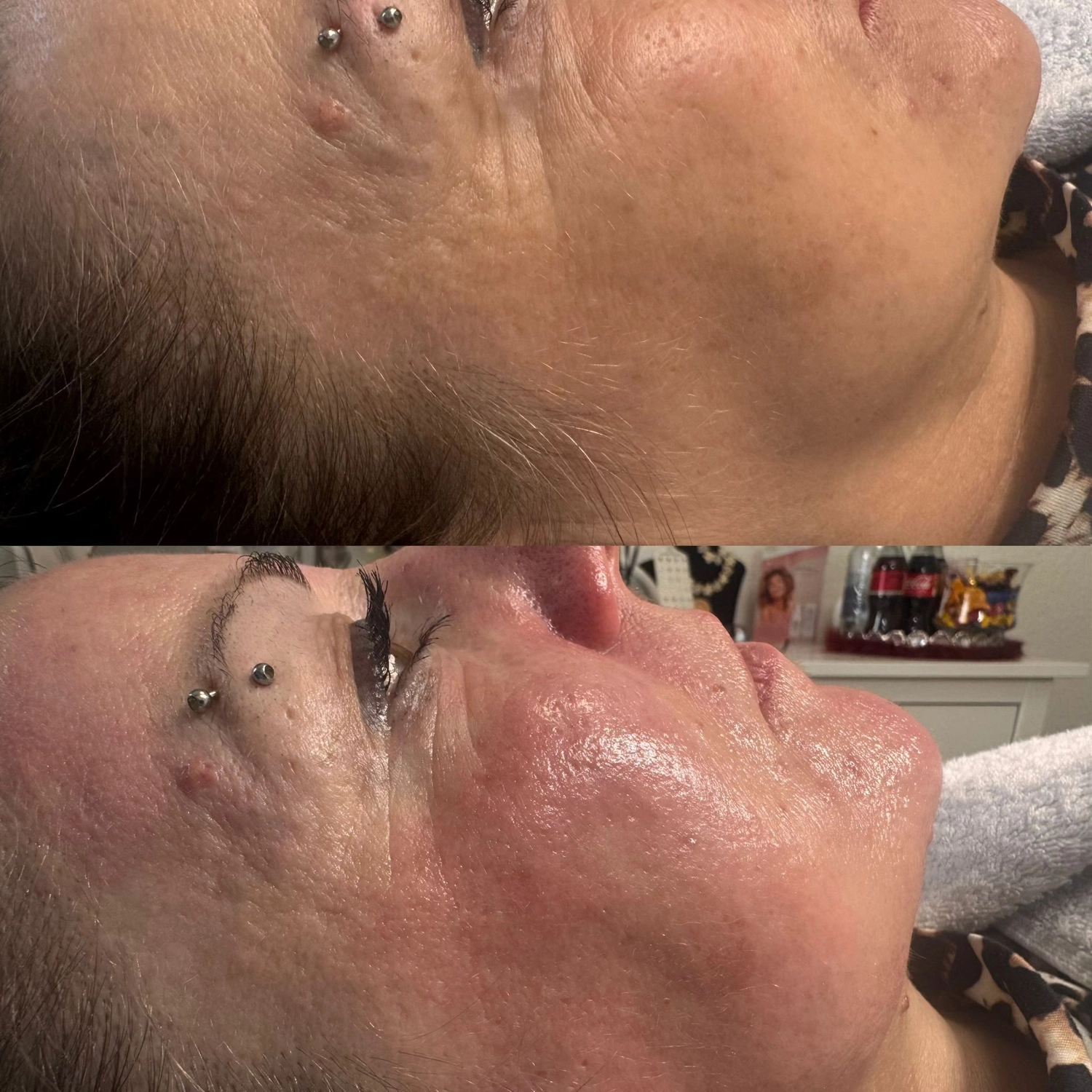 El barbero MB - Haar- und Hautpflegebehandlungen -  Vorher-Nachher-Bilder einer Microneedling-Behandlung im Gesicht einer Frau.