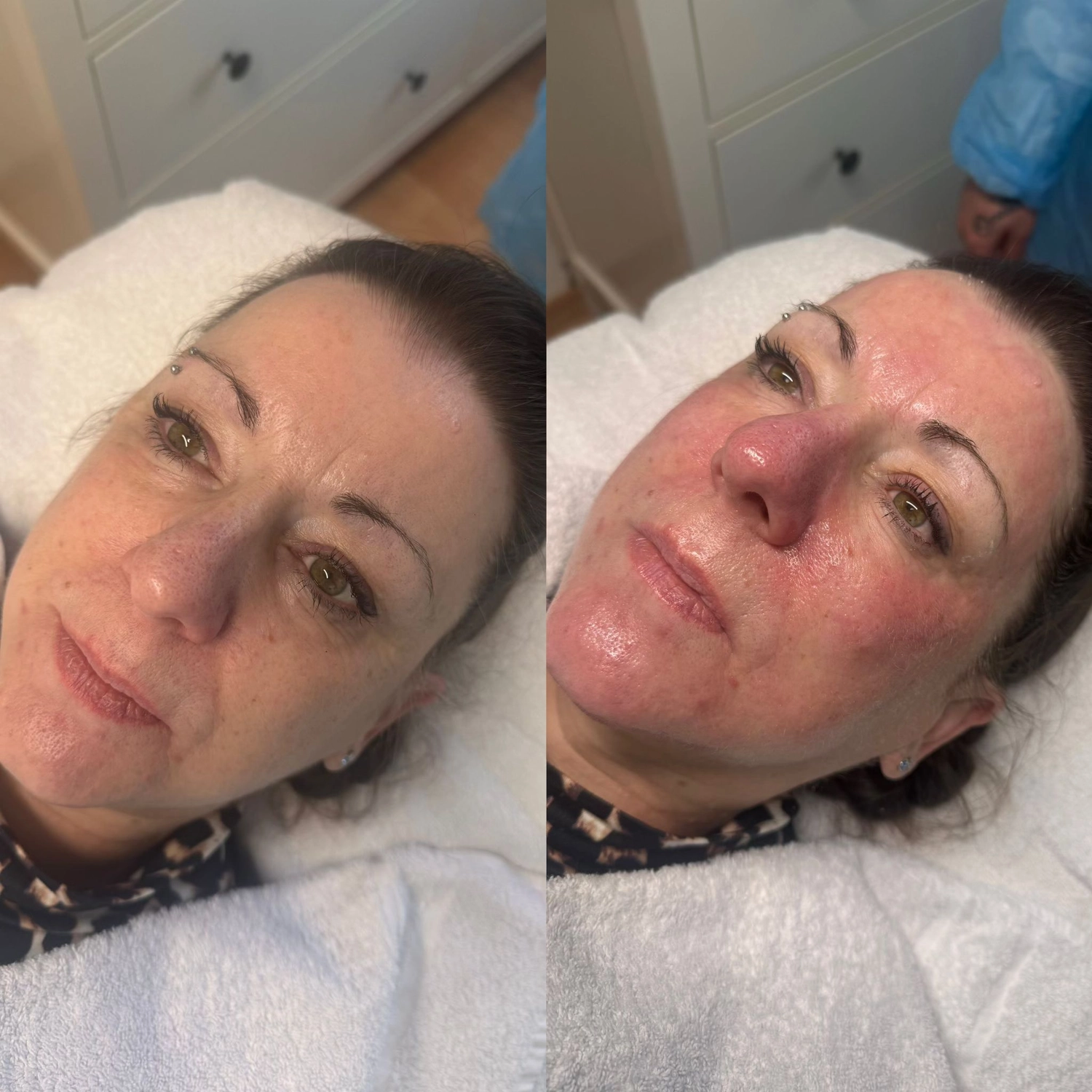 El barbero MB - Haar- und Hautpflegebehandlungen -  Vorher-Nachher-Bilder einer Microneedling-Behandlung im Gesicht einer Frau.